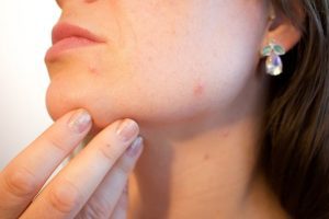 akne-bubuljice-Foto-Kjerstin-Michaela-Haraldsen-Pixabay-acne-1606765_1280