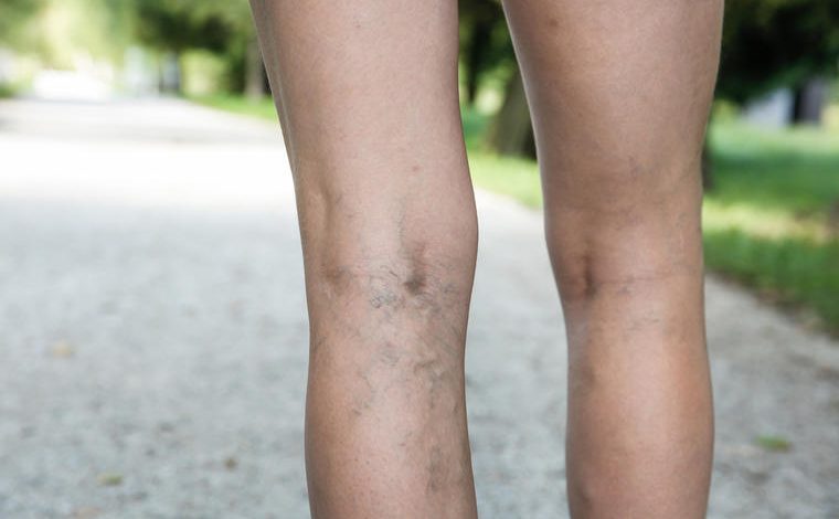 kako izlečiti proširene vene na nogama?