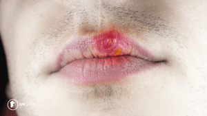 herpes na usnama