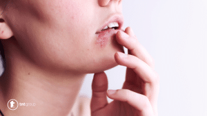 herpes na usnama