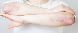 Acute psoriasis on elbows is an autoimmune incurable dermatological skin disease. Large red, inflamed, flaky rash on the knees. Joints affected by psoriatic arthritis.