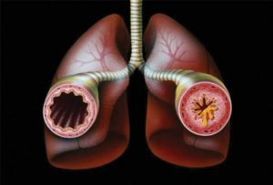 bronchial-wall-in-asthma