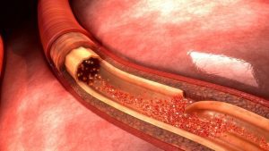 pucanje-aorte-shutterstock_451619509-910x512-1