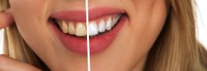 teeth-2414909_1920