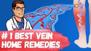 Video Thumbnail: #1 Best Varicose Vein Home Remedies [Spider Veins in Legs Treatment]