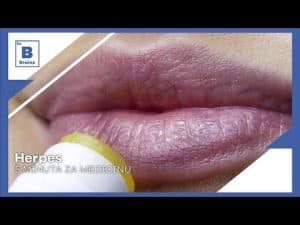 Video Thumbnail: 5 minuta za medicinu - Herpes